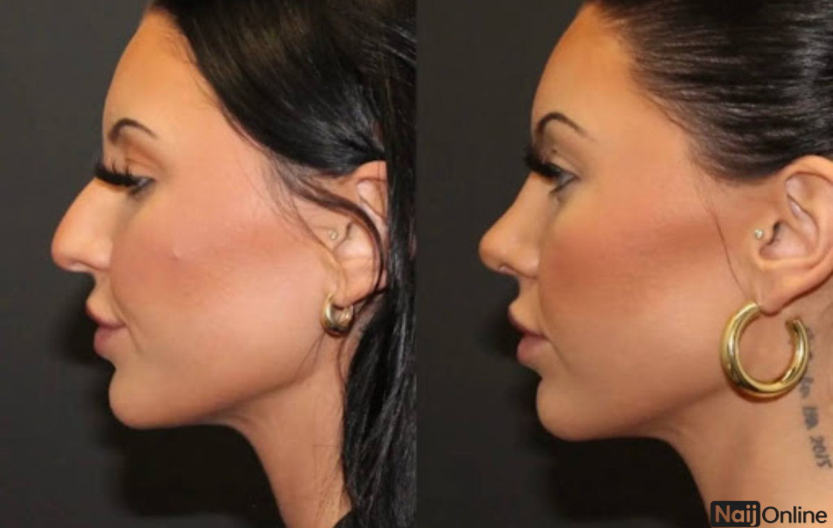 How Much Does a Nose Job Cost